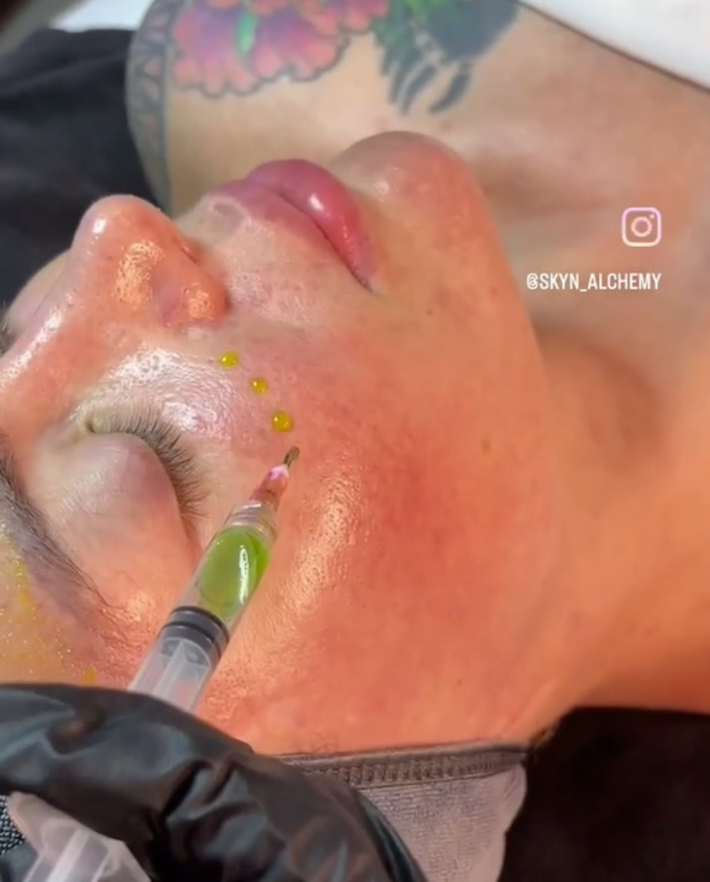 Aesthetician performing a facial injection treatment during a chemical peels session.