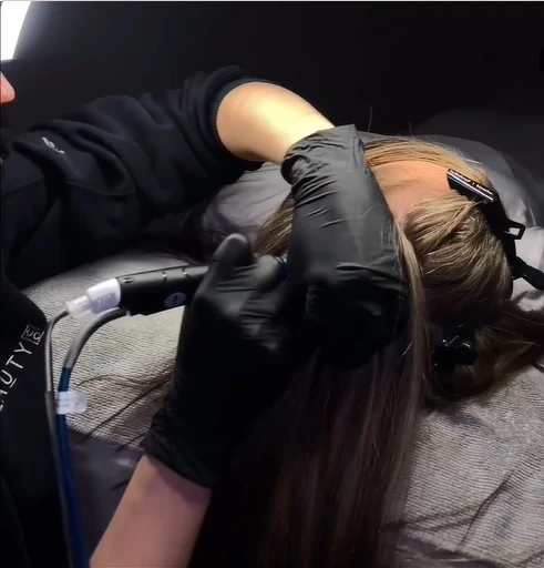 Specialist performing a Keravive procedure for scalp health.
