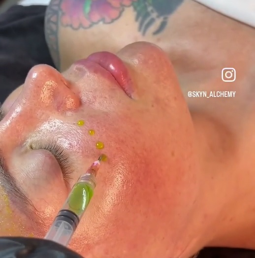 Close-up of a Perfect Derma Peel treatment being applied near the eye area.