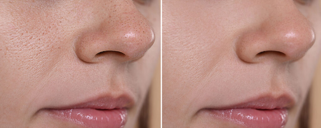 Before and after comparison showing improved skin texture and clarity following a bespoke facial.