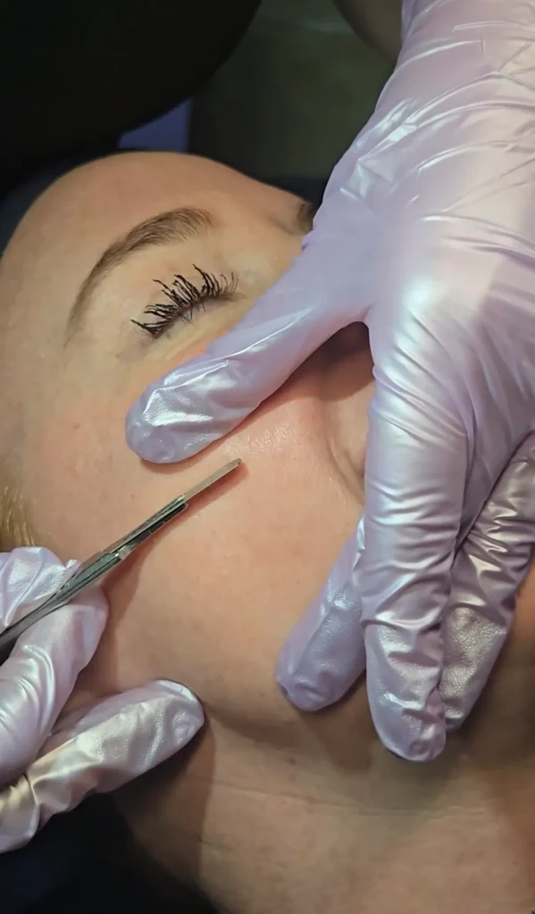Gloved hands using a dermaplaning tool on the cheek of a reclining person.