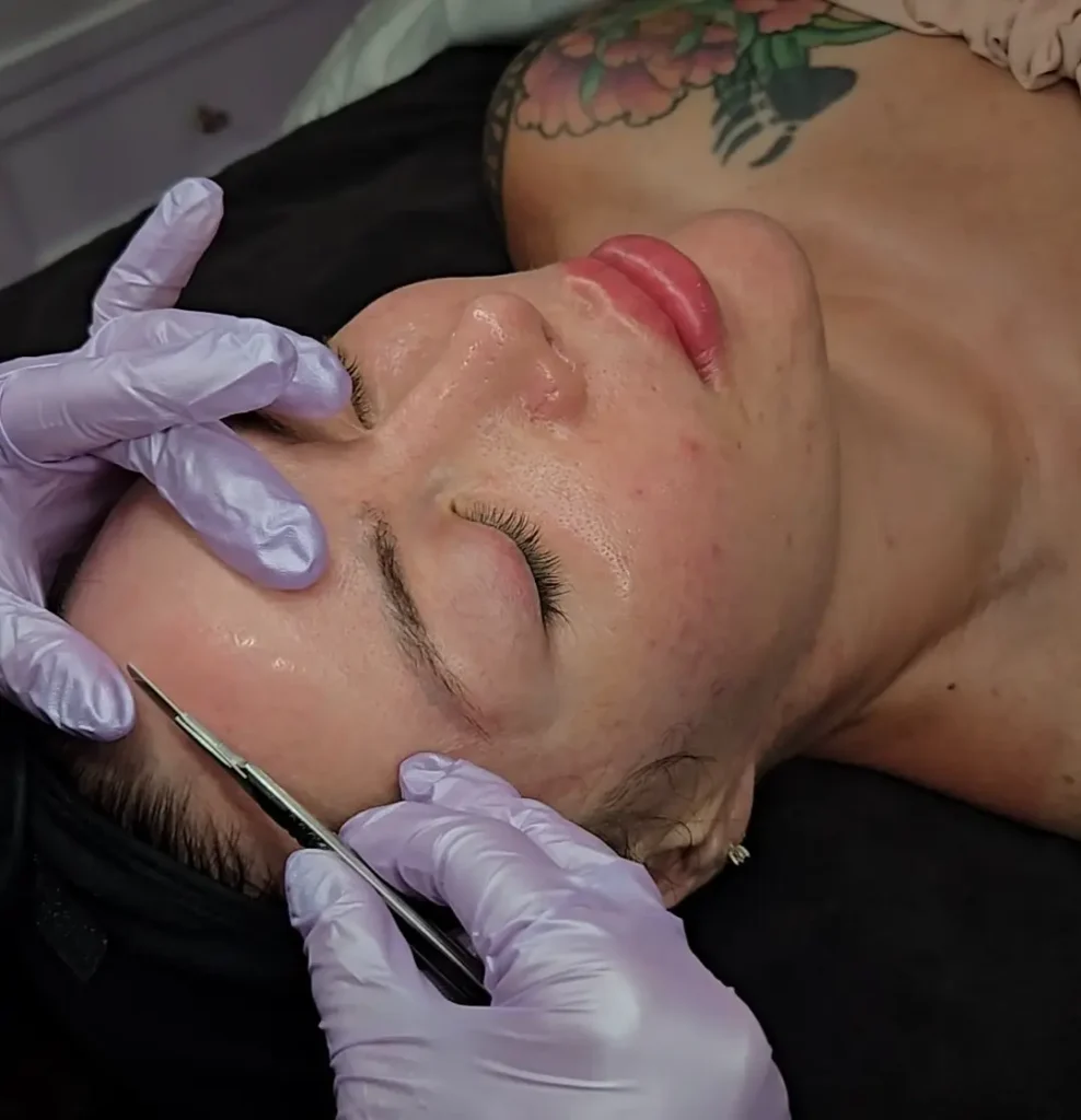 Person lying on a treatment bed while a gloved hand uses a dermaplaning tool on the forehead.