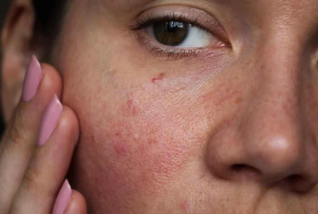 Close-up of a person's cheek with mild redness and visible superficial blood vessels.