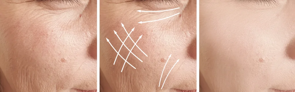 Three side-by-side close-up images of the same cheek showing skin texture with directional arrows in the center image.